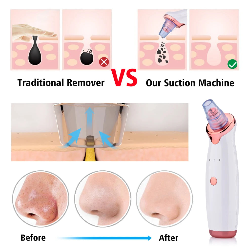 Electric Facial Blackhead Remover – Vacuum Pore Cleaner for Acne and Black Spots
