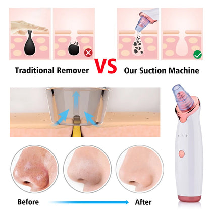 Electric Facial Blackhead Remover – Vacuum Pore Cleaner for Acne and Black Spots